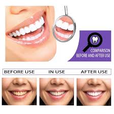Happy woman showing white teeth after using ProDentim dental formula