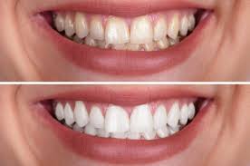 Does PowerBite really work? Customer testimonials and results