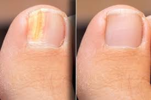 Does SupraNail really work? Powerful natural ingredients for nail repair